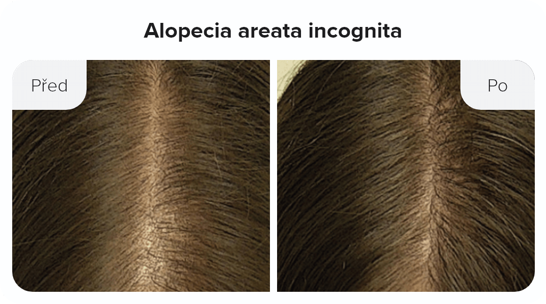 Alopecia areata incognita