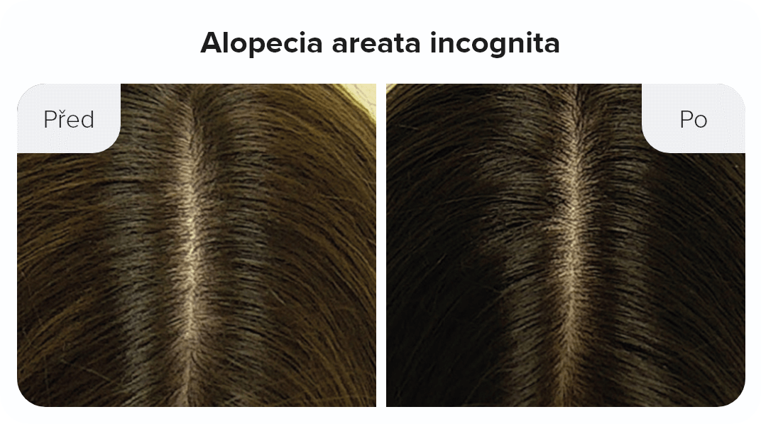 Alopecia areata incognita