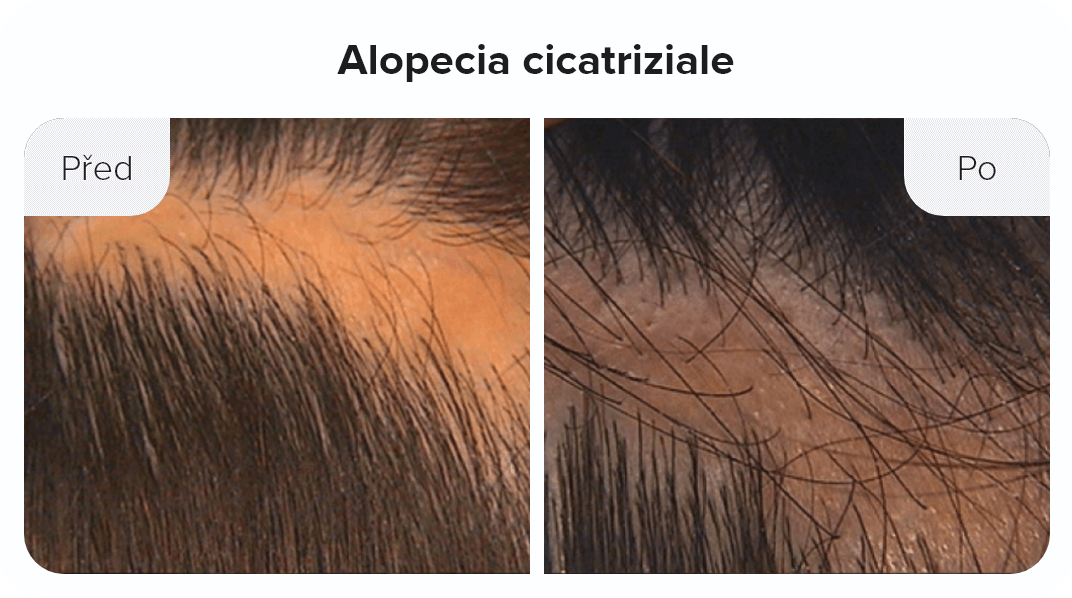 Alopecia cicatriziale