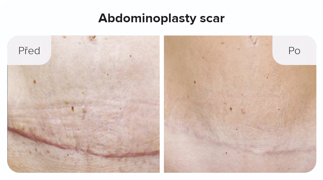 Abdominoplasty scar