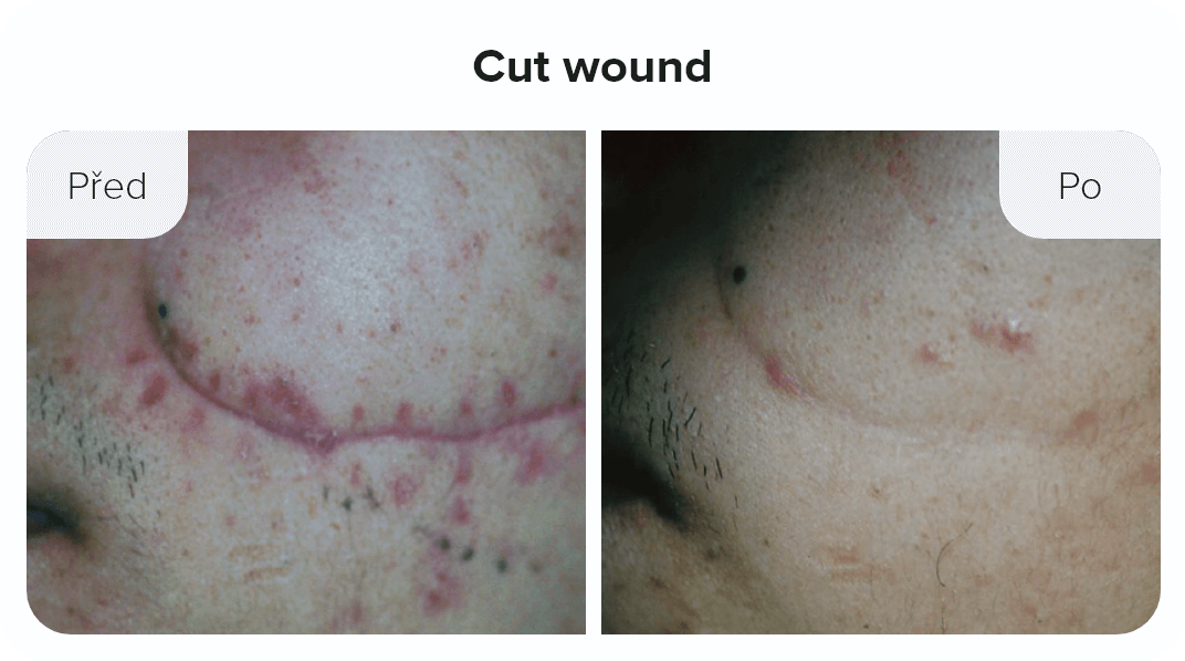 Cut wound