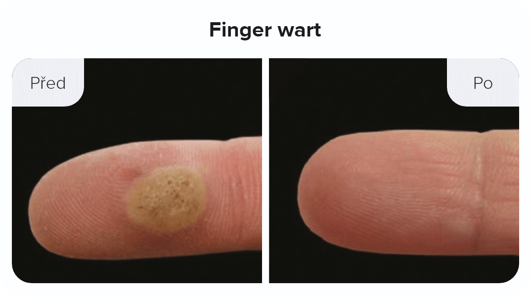 Finger wart