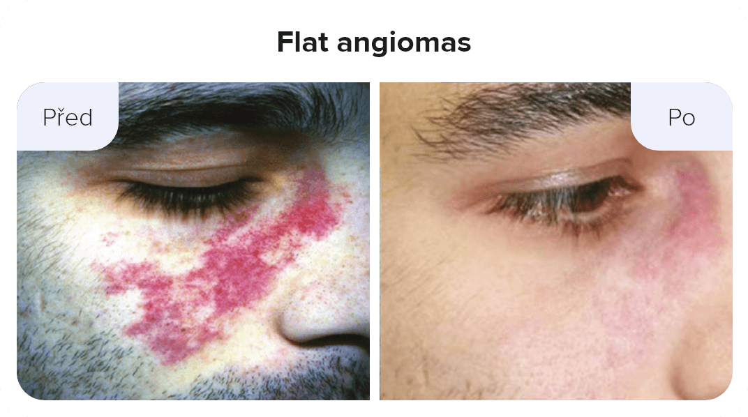 flat angiomas