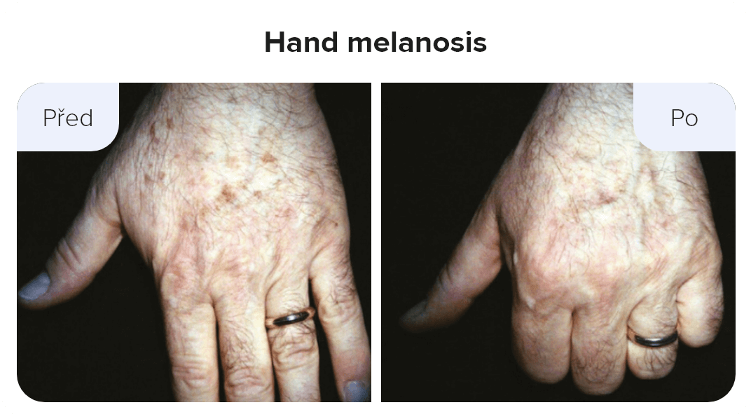 Hand melanosis
