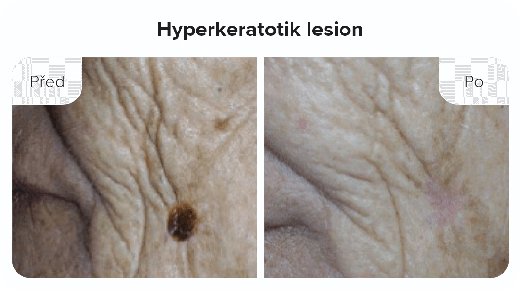 Hyperkeratotik lesion