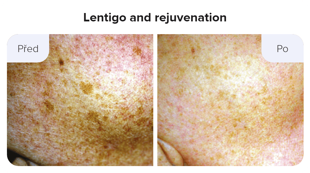 Lentigo and rejuvenation