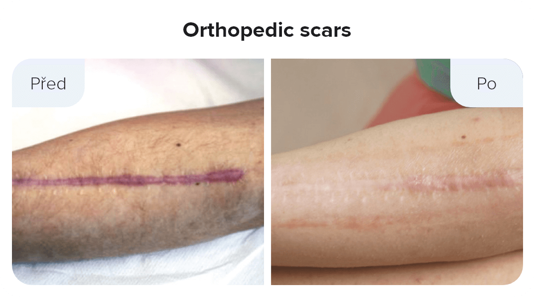 Orthopedic scars