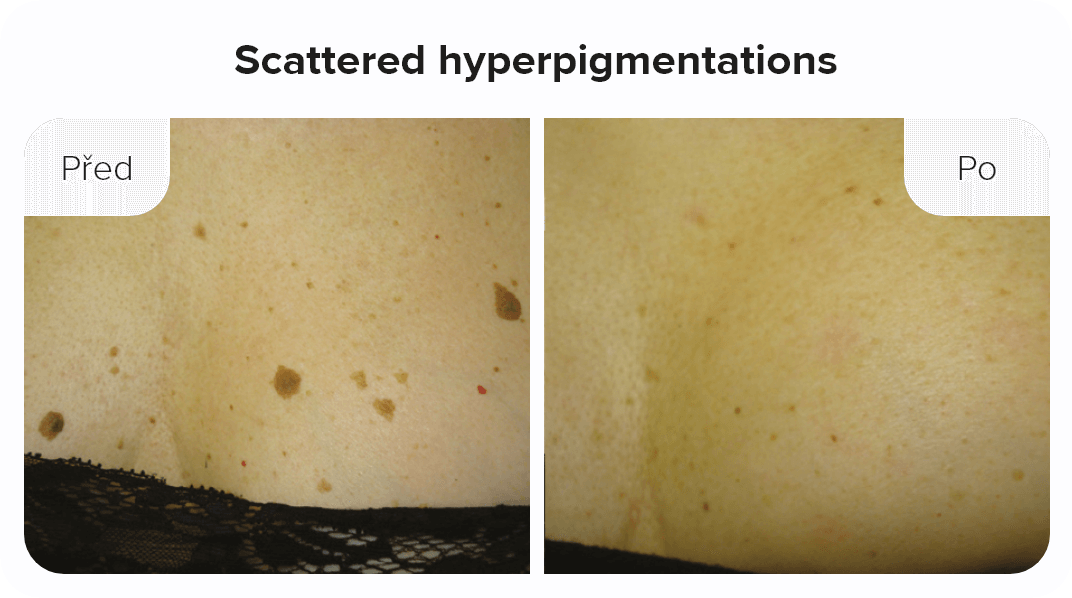 Scattered hyperpigmentations