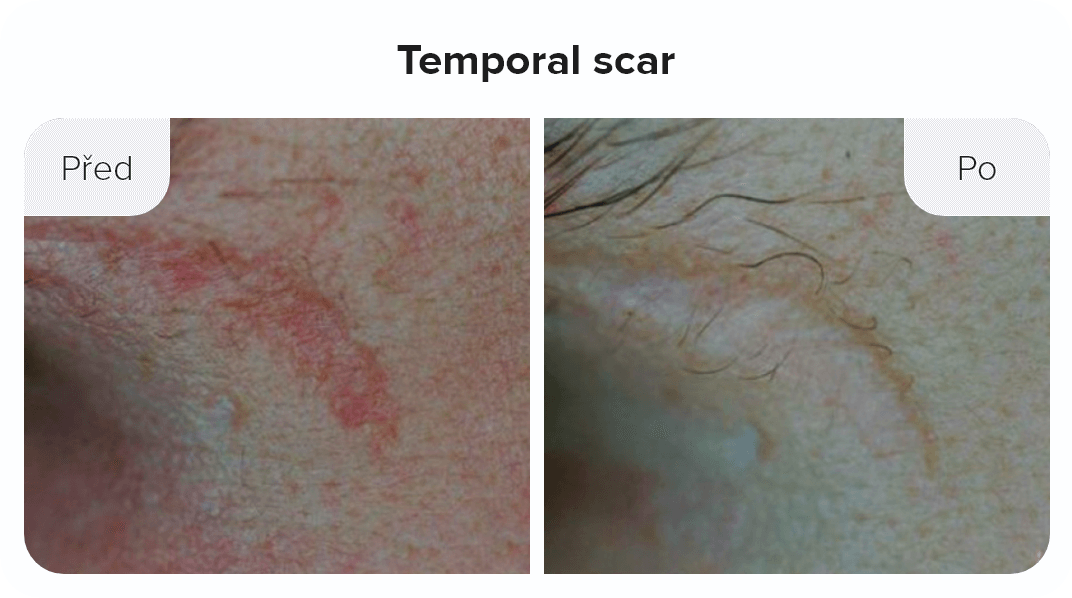 Temporal scar