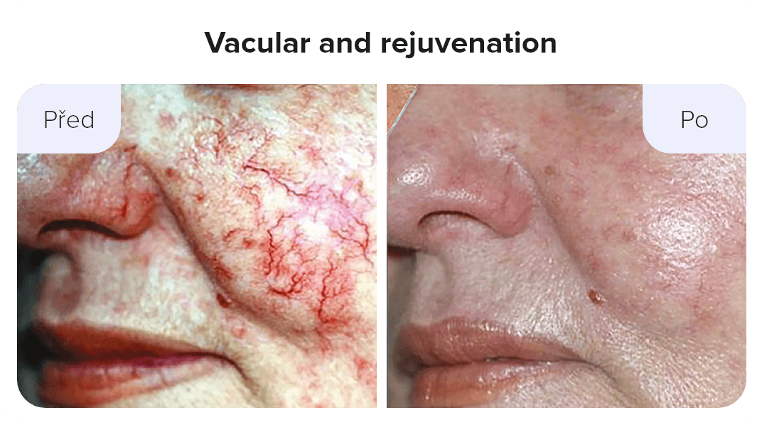 Vacular and rejuvenation